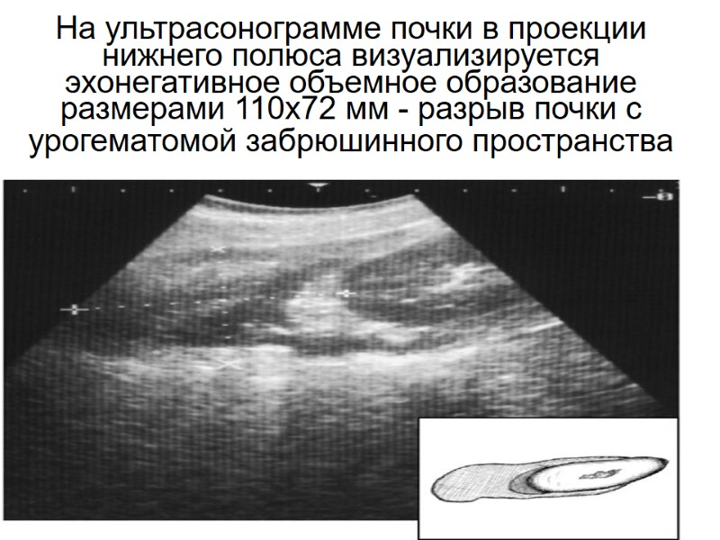 На ультрасонограмме почки в проекции нижнего полюса визуализируется эхонегативное объемное образование размерами 110х72 мм